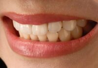 asian smile, anterior teeth, veneer, porcelain veneer, lip, beauty, veneer, veneer, veneer, veneer, veneer